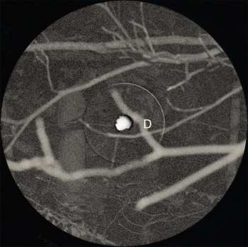 2LP Tongue Depressor: Bones For Time